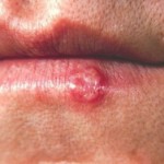 Herpes na usni lečenje