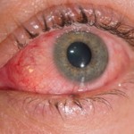 Vidova trava ili vidac za vid upalu oka i nosne sluznice