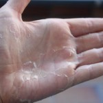 Ljuštenje kože na dlanovima rukama nogama i razlozi