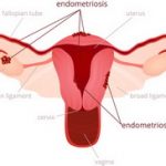 Šta je endometrioza simptomi i kako se leči